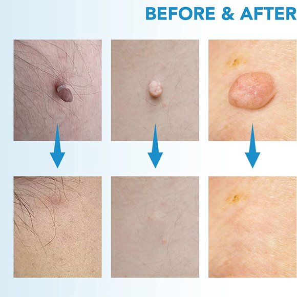 Auto Micro Skin Tag Remover Device Kit - Picture 5 of 8